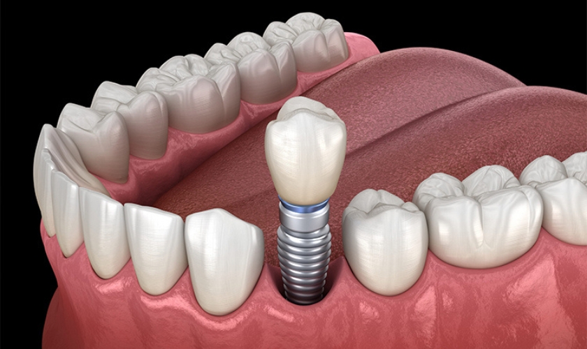 dental implants in Euless