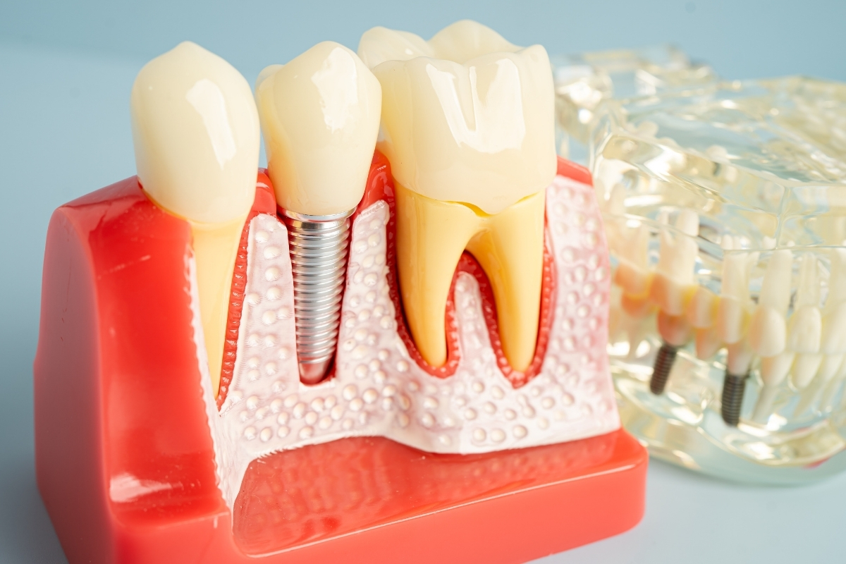 Dental Implants Euless